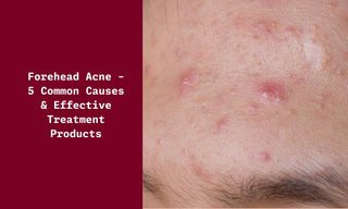 Forehead Acne - 5 Common Causes & Effective Treatment Products