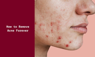 How to Remove Acne Forever?