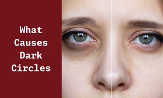 What Causes Dark Circles