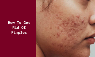 How to Get Rid of Pimples