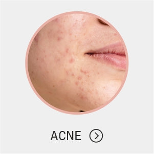 Acne