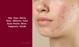 How Your Daily Diet Affects Your Acne-Prone Skin: Complete Guide  