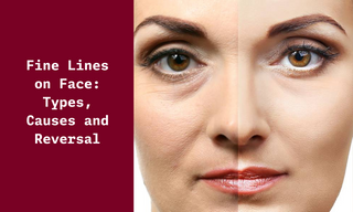 Fine Lines on Face: Types, Causes and Reversal