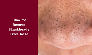 How to Remove Blackheads From Nose