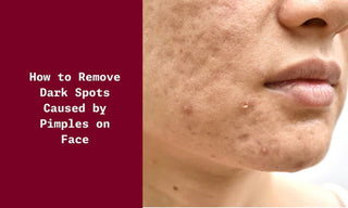 How to Remove Dark Spots Caused by Pimples on Face