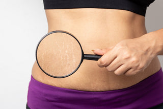 How to remove stretch marks permanently?