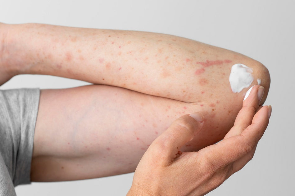 Intense Rashes Skin Rashes & Irritation Causes, Symptoms, Reasons & Treatment - Ningen
