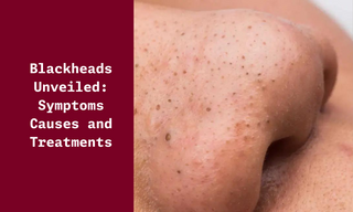 Blackheads Symptoms, Causes, and Treatments