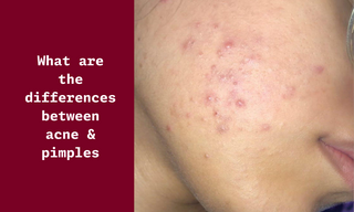 What Are The Differences Between Acne & Pimples?