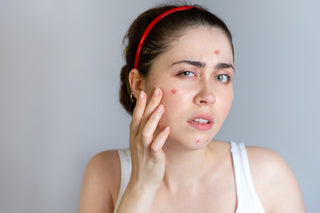 How to Prevent Pimples Coming on Your Face?