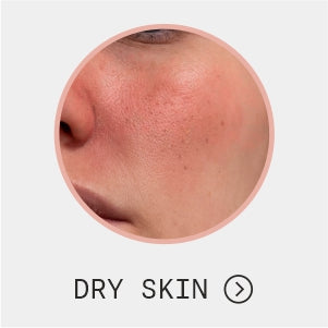 Dry Skin
