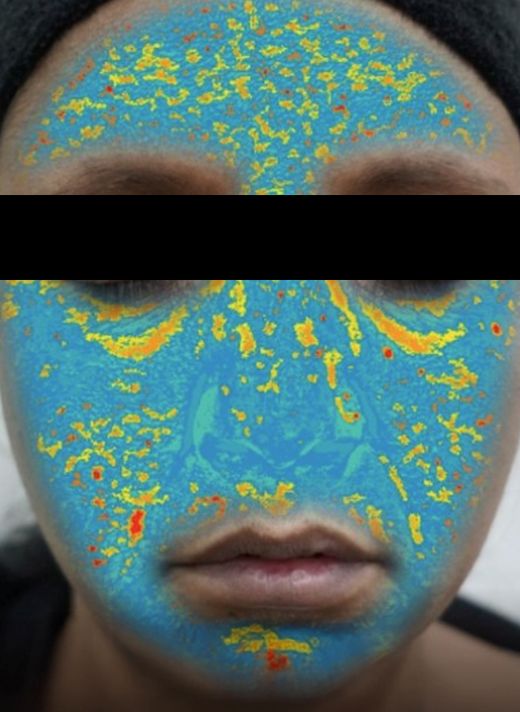 SkinSens AI analysis overlay on an Indian participant's face